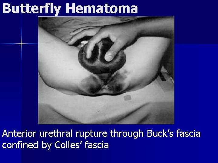 Butterfly Hematoma Anterior urethral rupture through Buck’s fascia confined by Colles’ fascia 