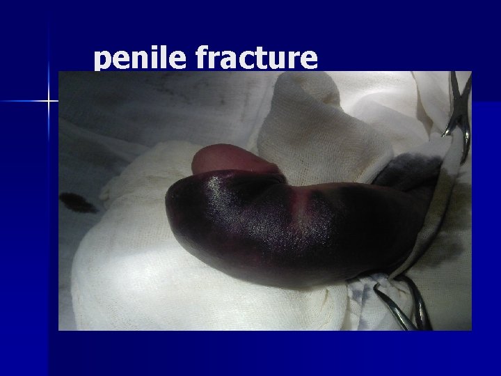 penile fracture 