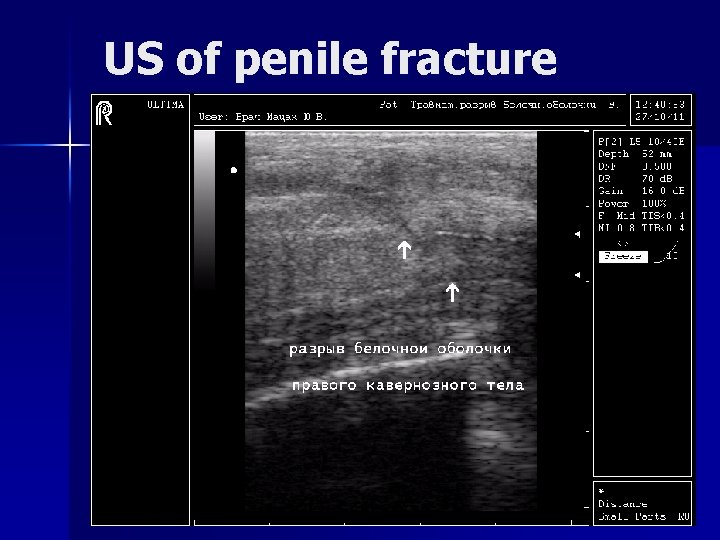 US of penile fracture 