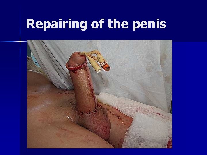 Repairing of the penis 