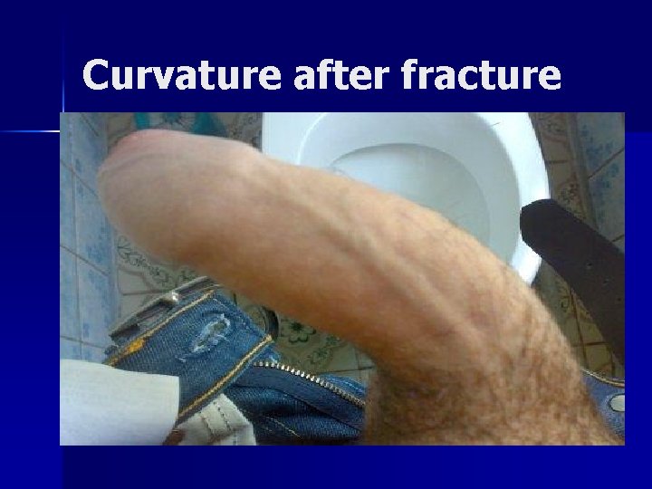 Curvature after fracture 