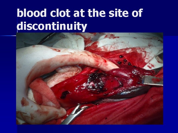 blood clot at the site of discontinuity 