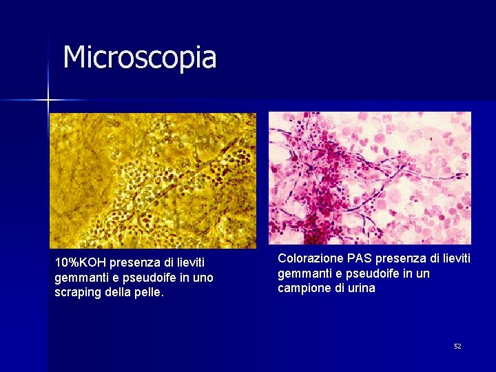 Microscopia 10%KOH presenza di lieviti gemmanti e pseudoife in uno scraping della pelle. Colorazione