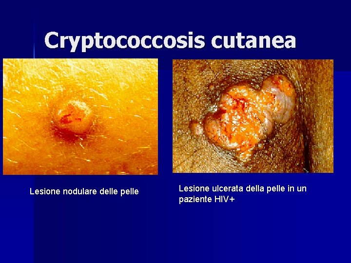 Cryptococcosis cutanea Lesione nodulare delle pelle Lesione ulcerata della pelle in un paziente HIV+