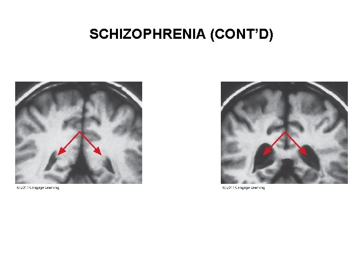 SCHIZOPHRENIA (CONT’D) 