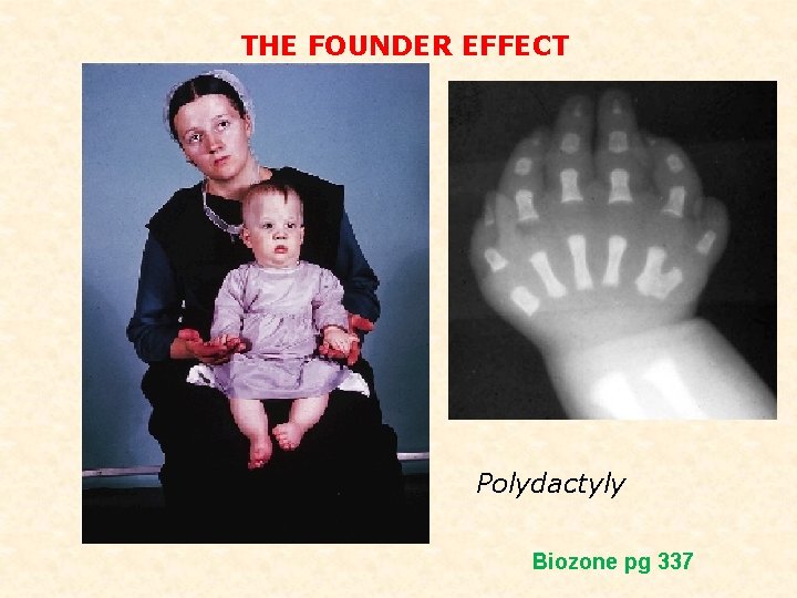 THE FOUNDER EFFECT Polydactyly Biozone pg 337 THE FOUNDER EFFECT Polydactyly Biozone pg 337