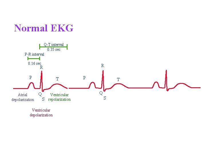 Normal EKG Q-T interval 0. 35 sec P-R interval 0. 16 sec R R