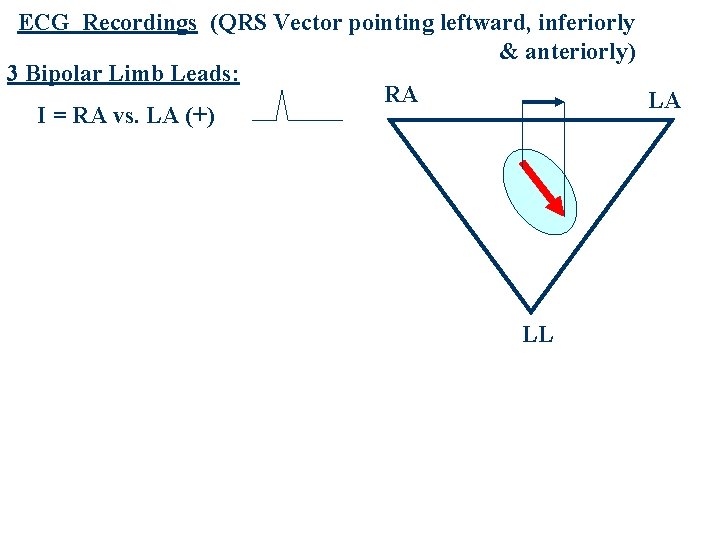 ECG Recordings (QRS Vector pointing leftward, inferiorly & anteriorly) 3 Bipolar Limb Leads: RA