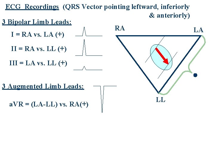 ECG Recordings (QRS Vector pointing leftward, inferiorly & anteriorly) 3 Bipolar Limb Leads: RA