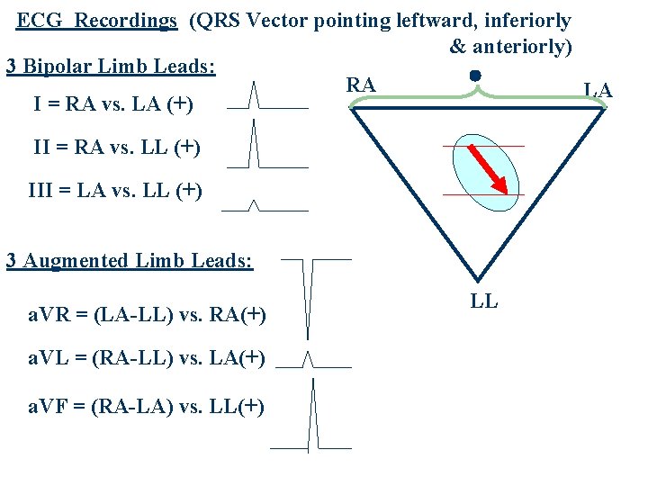 ECG Recordings (QRS Vector pointing leftward, inferiorly & anteriorly) 3 Bipolar Limb Leads: RA