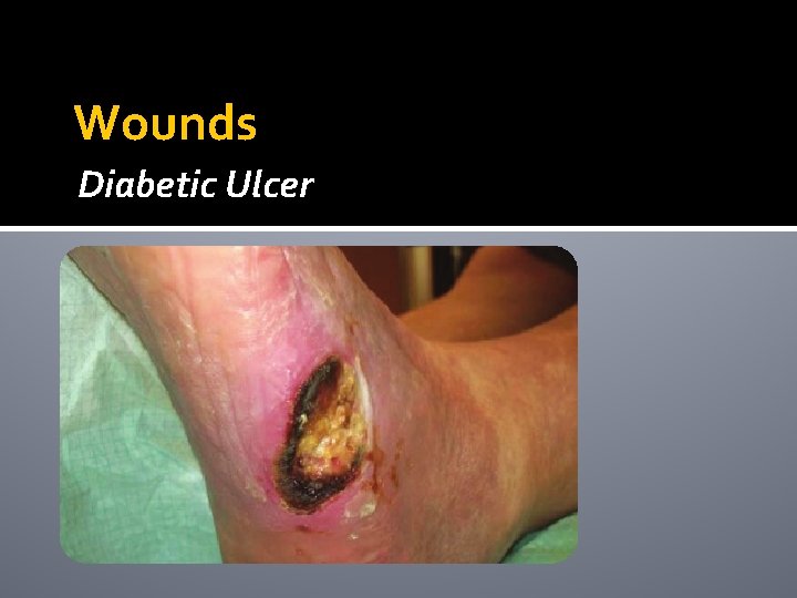 Wounds Diabetic Ulcer Wounds Diabetic Ulcer