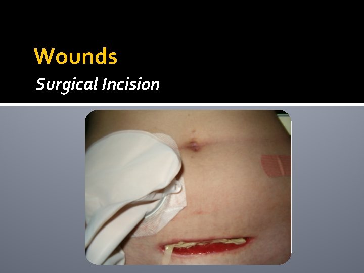 Wounds Surgical Incision Wounds Surgical Incision