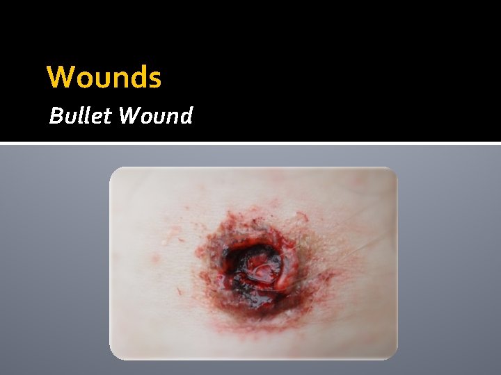 Wounds Bullet Wound Wounds Bullet Wound