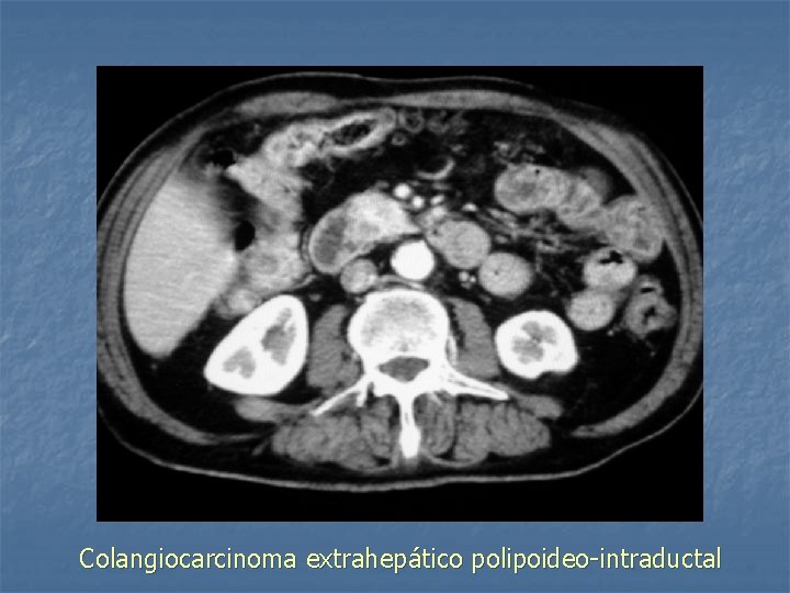 Colangiocarcinoma extrahepático polipoideo-intraductal 