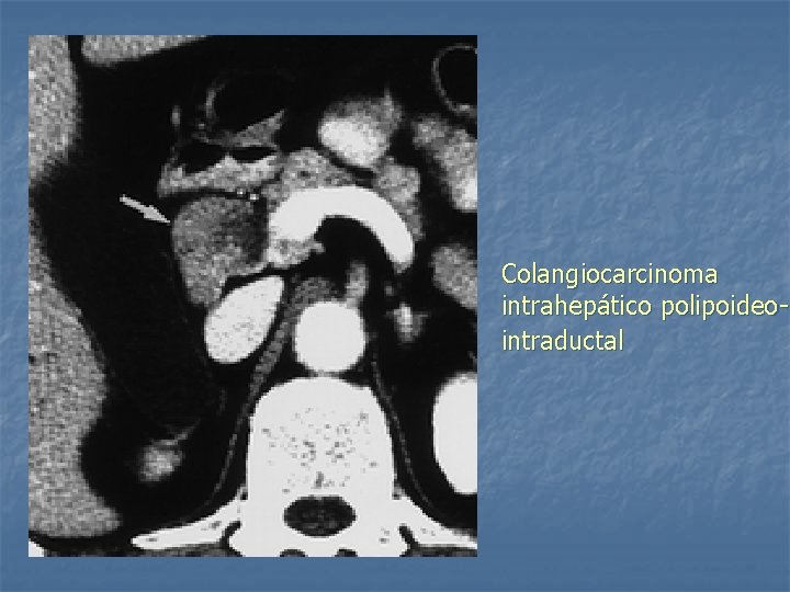 Colangiocarcinoma intrahepático polipoideointraductal 