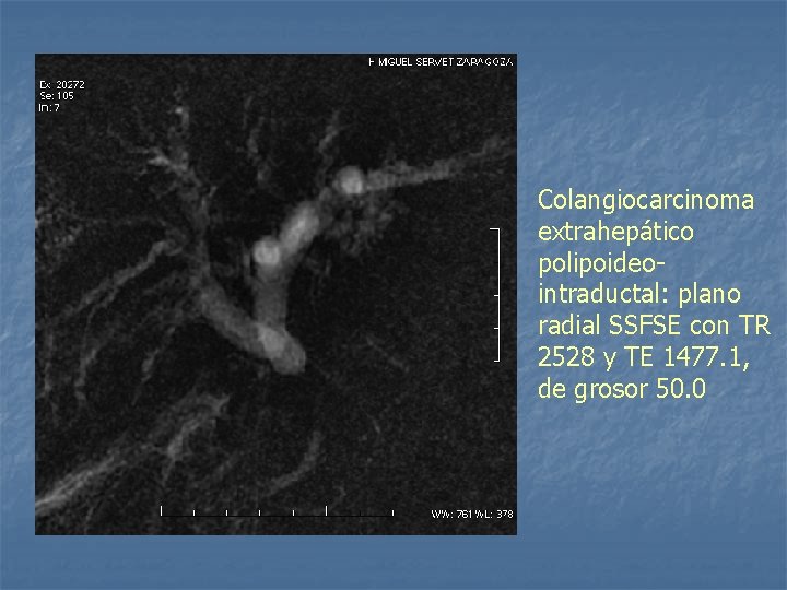 Colangiocarcinoma extrahepático polipoideointraductal: plano radial SSFSE con TR 2528 y TE 1477. 1, de