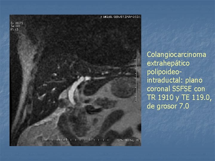 Colangiocarcinoma extrahepático polipoideointraductal: plano coronal SSFSE con TR 1910 y TE 119. 0, de