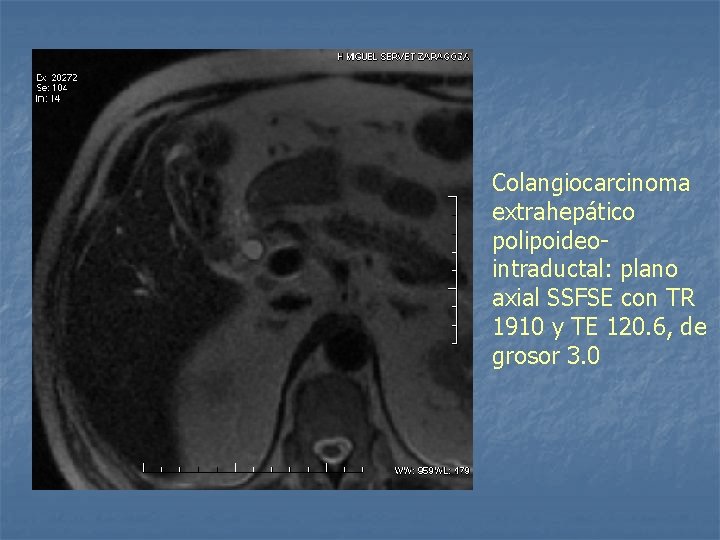 Colangiocarcinoma extrahepático polipoideointraductal: plano axial SSFSE con TR 1910 y TE 120. 6, de