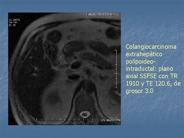 Colangiocarcinoma extrahepático polipoideointraductal: plano axial SSFSE con TR 1910 y TE 120. 6, de