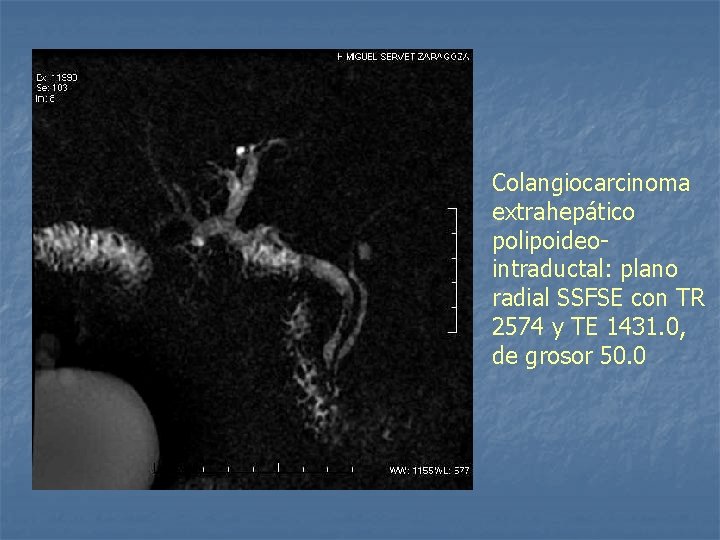 Colangiocarcinoma extrahepático polipoideointraductal: plano radial SSFSE con TR 2574 y TE 1431. 0, de