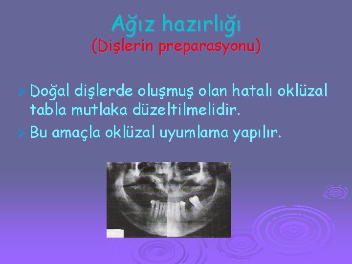 Ağız hazırlığı (Dişlerin preparasyonu) Ø Doğal dişlerde oluşmuş olan hatalı oklüzal tabla mutlaka düzeltilmelidir.