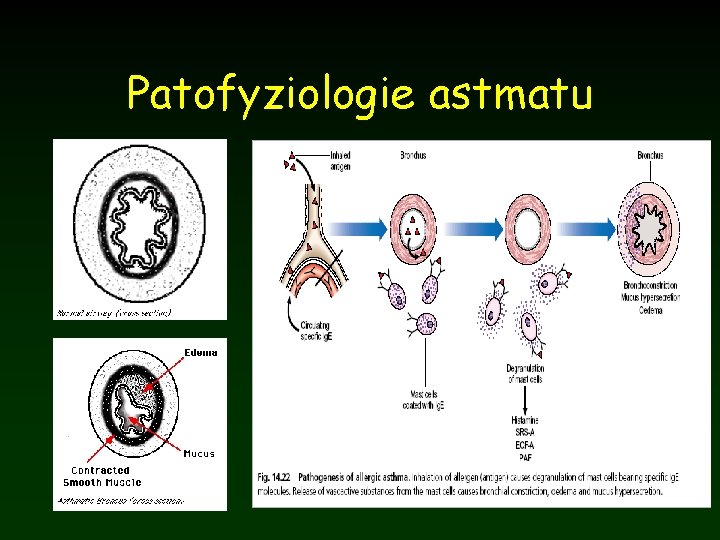 Patofyziologie astmatu 