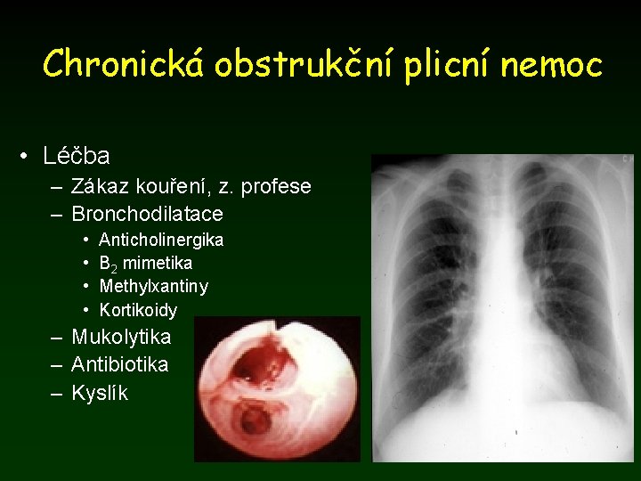 Chronická obstrukční plicní nemoc • Léčba – Zákaz kouření, z. profese – Bronchodilatace •