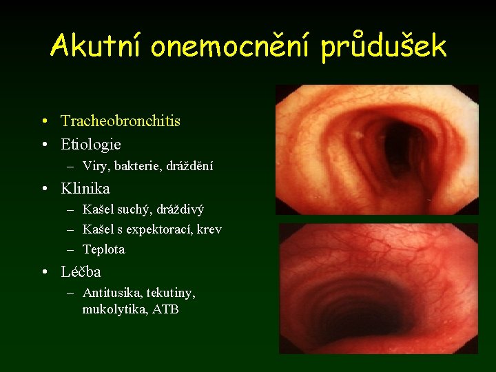 Akutní onemocnění průdušek • Tracheobronchitis • Etiologie – Viry, bakterie, dráždění • Klinika –