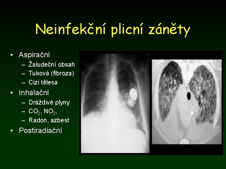 Neinfekční plicní záněty • Aspirační – Žaludeční obsah – Tuková (fibroza) – Cizí tělesa