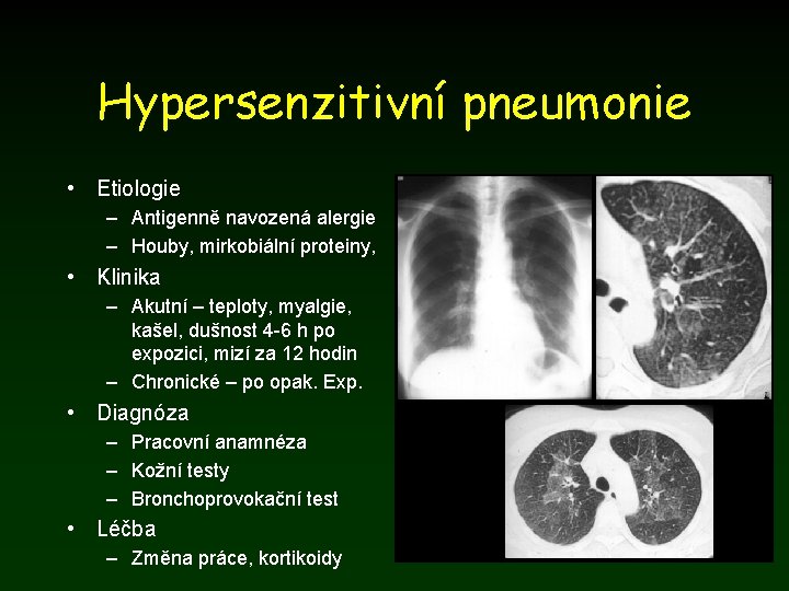 Hypersenzitivní pneumonie • Etiologie – Antigenně navozená alergie – Houby, mirkobiální proteiny, • Klinika