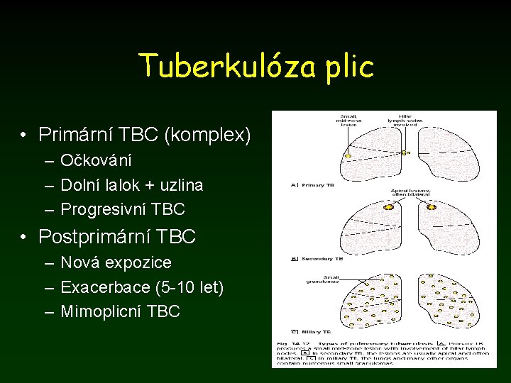 Tuberkulóza plic • Primární TBC (komplex) – Očkování – Dolní lalok + uzlina –