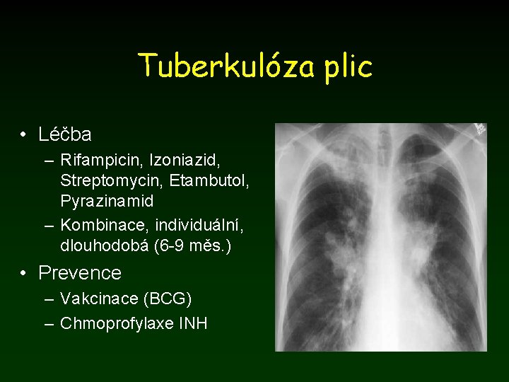Tuberkulóza plic • Léčba – Rifampicin, Izoniazid, Streptomycin, Etambutol, Pyrazinamid – Kombinace, individuální, dlouhodobá