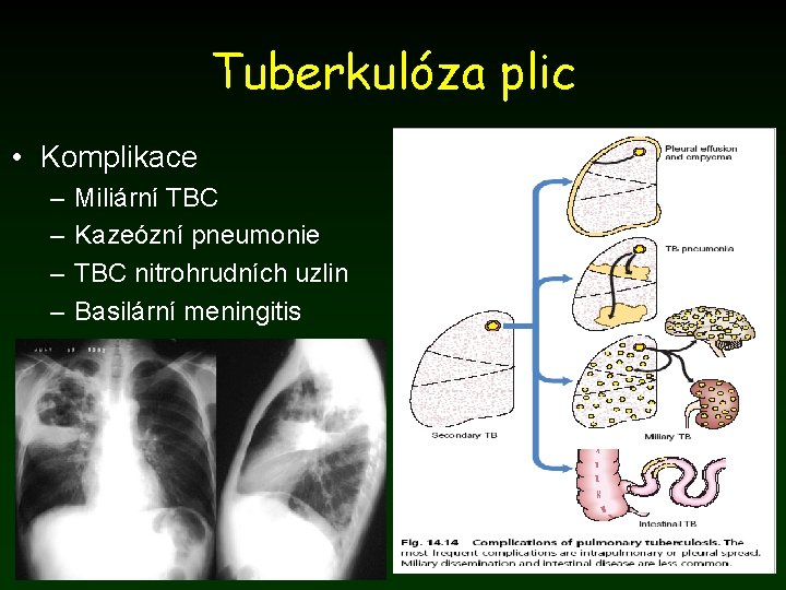 Tuberkulóza plic • Komplikace – – Miliární TBC Kazeózní pneumonie TBC nitrohrudních uzlin Basilární