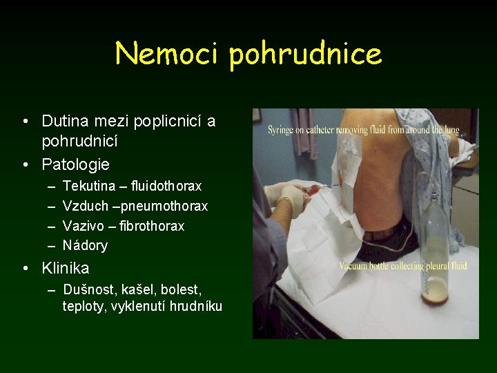 Nemoci pohrudnice • Dutina mezi poplicnicí a pohrudnicí • Patologie – – Tekutina –