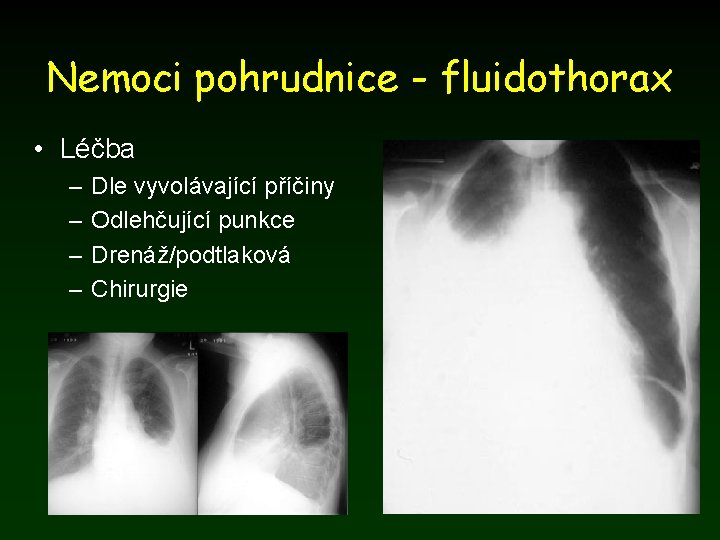 Nemoci pohrudnice - fluidothorax • Léčba – – Dle vyvolávající příčiny Odlehčující punkce Drenáž/podtlaková