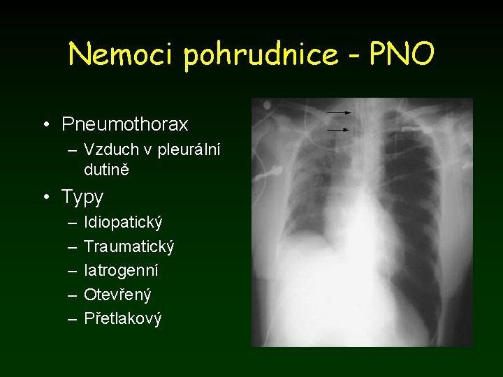 Nemoci pohrudnice - PNO • Pneumothorax – Vzduch v pleurální dutině • Typy –