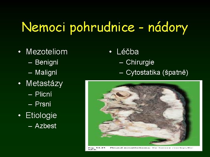 Nemoci pohrudnice - nádory • Mezoteliom – Benigní – Maligní • Metastázy – Plicní