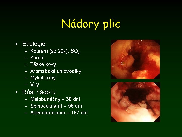 Nádory plic • Etiologie – – – Kouření (až 20 x), SO 2 Záření