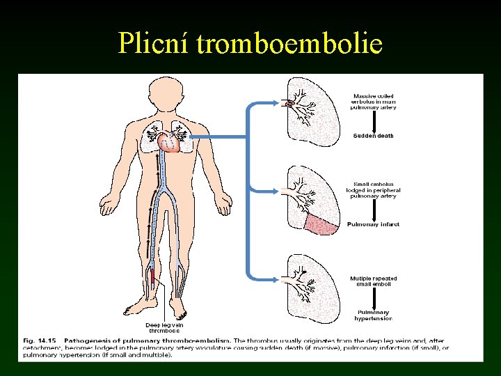 Plicní tromboembolie 