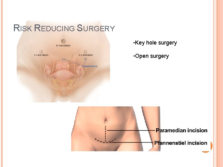RISK REDUCING SURGERY • Key hole surgery • Open surgery 