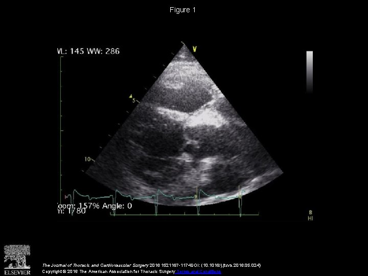 Figure 1 The Journal of Thoracic and Cardiovascular Surgery 2016 1521167 -1174 DOI: (10.