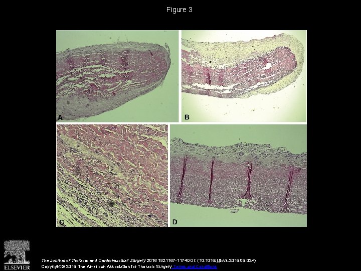 Figure 3 The Journal of Thoracic and Cardiovascular Surgery 2016 1521167 -1174 DOI: (10.