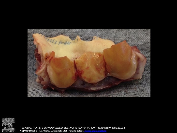 The Journal of Thoracic and Cardiovascular Surgery 2016 1521167 -1174 DOI: (10. 1016/j. jtcvs.