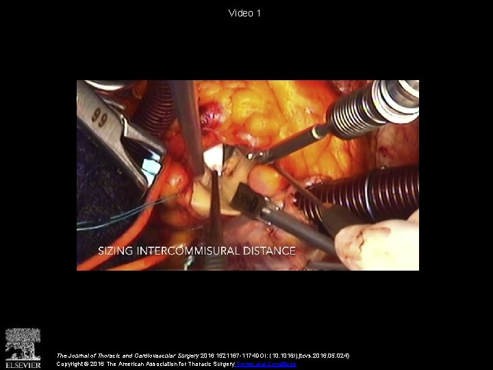 Video 1 The Journal of Thoracic and Cardiovascular Surgery 2016 1521167 -1174 DOI: (10.