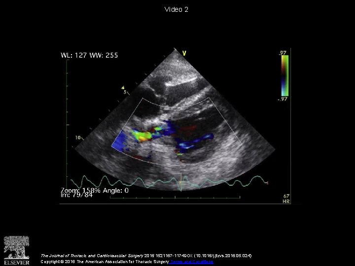 Video 2 The Journal of Thoracic and Cardiovascular Surgery 2016 1521167 -1174 DOI: (10.