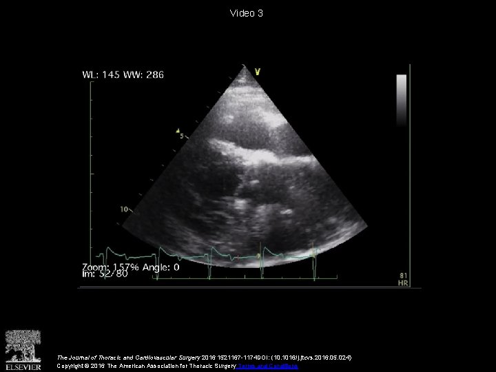 Video 3 The Journal of Thoracic and Cardiovascular Surgery 2016 1521167 -1174 DOI: (10.