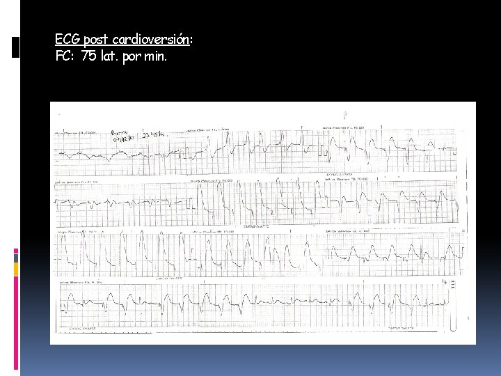 ECG post cardioversión: FC: 75 lat. por min. 