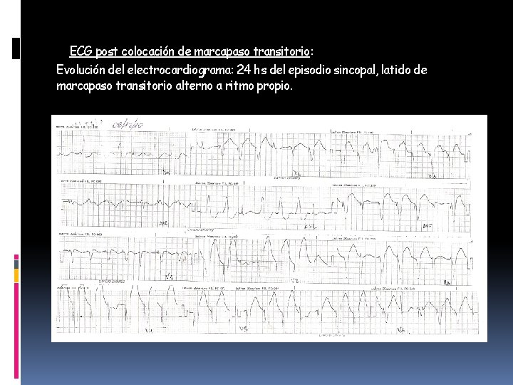 ECG post colocación de marcapaso transitorio: Evolución del electrocardiograma: 24 hs del episodio sincopal,