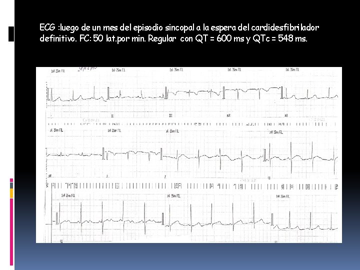 ECG : luego de un mes del episodio sincopal a la espera del cardidesfibrilador