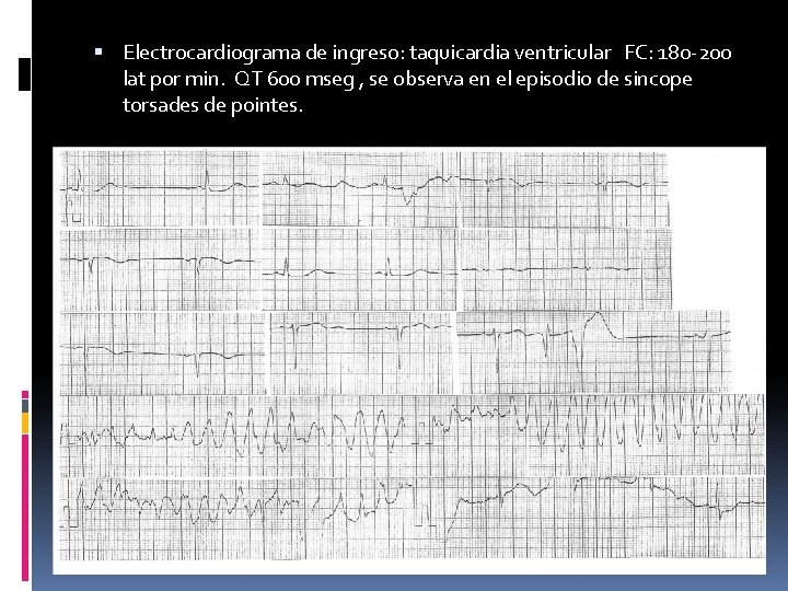  Electrocardiograma de ingreso: taquicardia ventricular FC: 180 -200 lat por min. QT 600